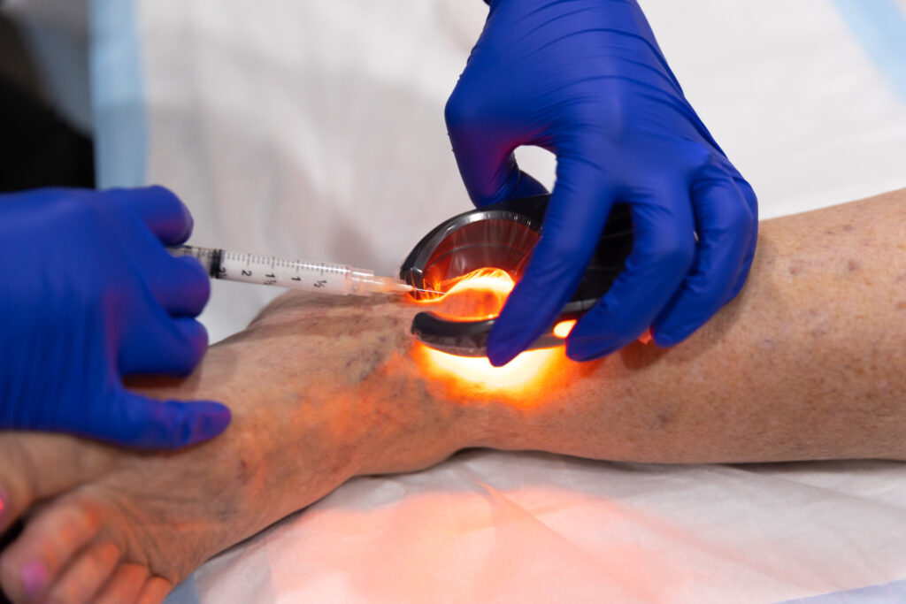 A vein specialist uses a vein light and sclerotherapy injection to provide spider vein treatment near Sebring.